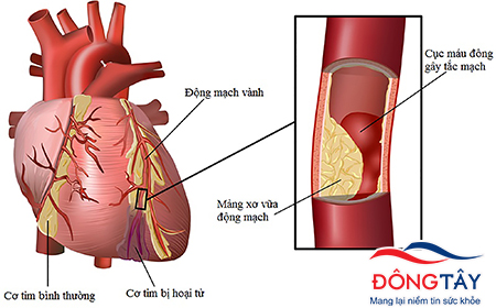 Mỡ máu là nguy cơ cao của các bệnh tim mạch